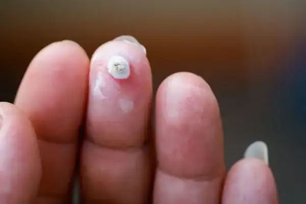 Image of white wart before cryopen treatment Sevenoaks