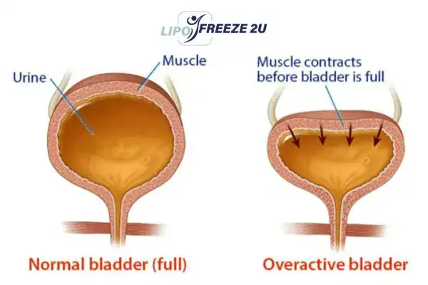 diagram of overactive bladder treatment Sevenoaks