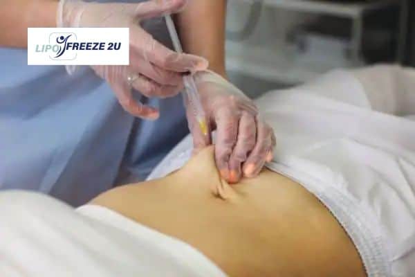 How Does Aqualyx Fat Dissolving Injection Work to Break Down Fat Sevenoaks?