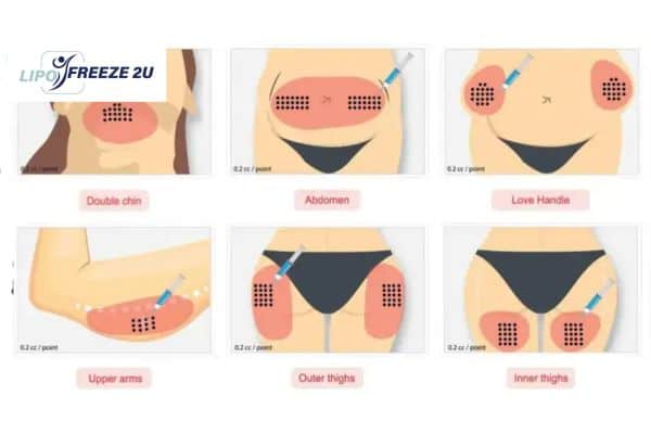 Benefits of Choosing Aqualyx for Fat Reduction Sevenoaks