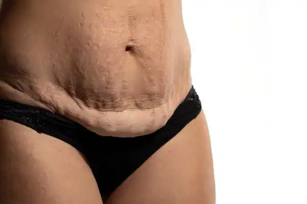 loose skin after weight loss injections Sevenoaks