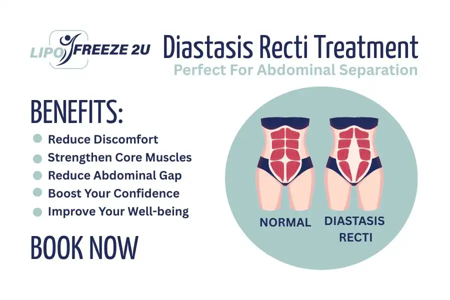 How Long Will It Take to See Improvements in Diastasis Recti Sevenoaks
