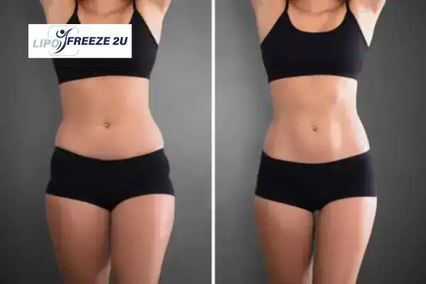 How Can LIPO FREEZE 2U Support Your Post-Pregnancy Body Recovery Sevenoaks?
