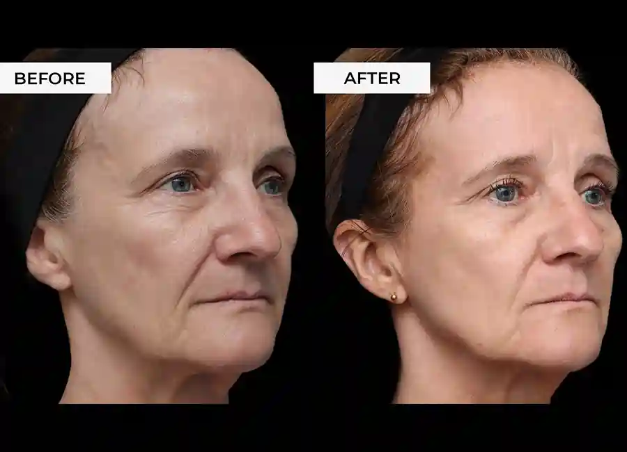 How Many RF Microneedling Sessions Will You Need to See a Difference Sevenoaks?