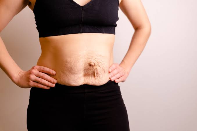 Is Surgery Really the Only Way to Repair Diastasis Recti Sevenoaks?