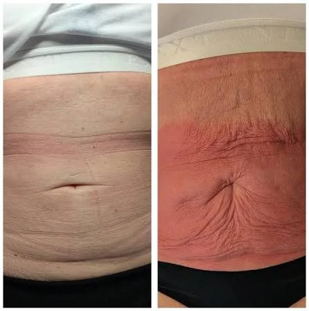 How Does RF Microneedling Improve Crepey, Thin and Uneven Skin Texture Sevenoaks?