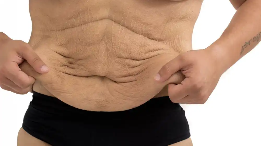 RF Microneedling for Loose Skin: How Can It Help Tighten and Reshape the Skin Sevenoaks?